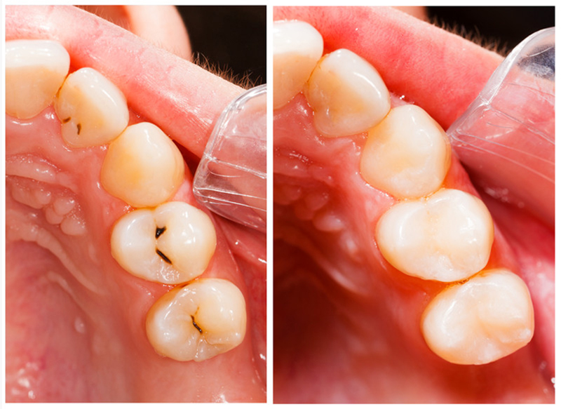 Fillings  Pelzer, SC 