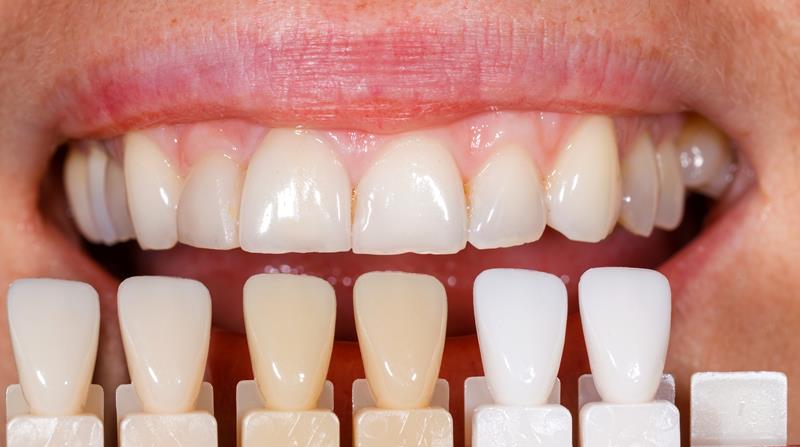 Veneers Pelzer, SC